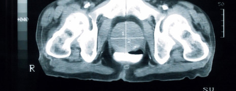 Prostata